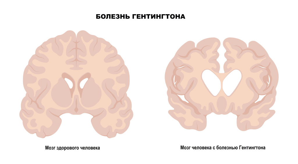 Гентингтон.jpg