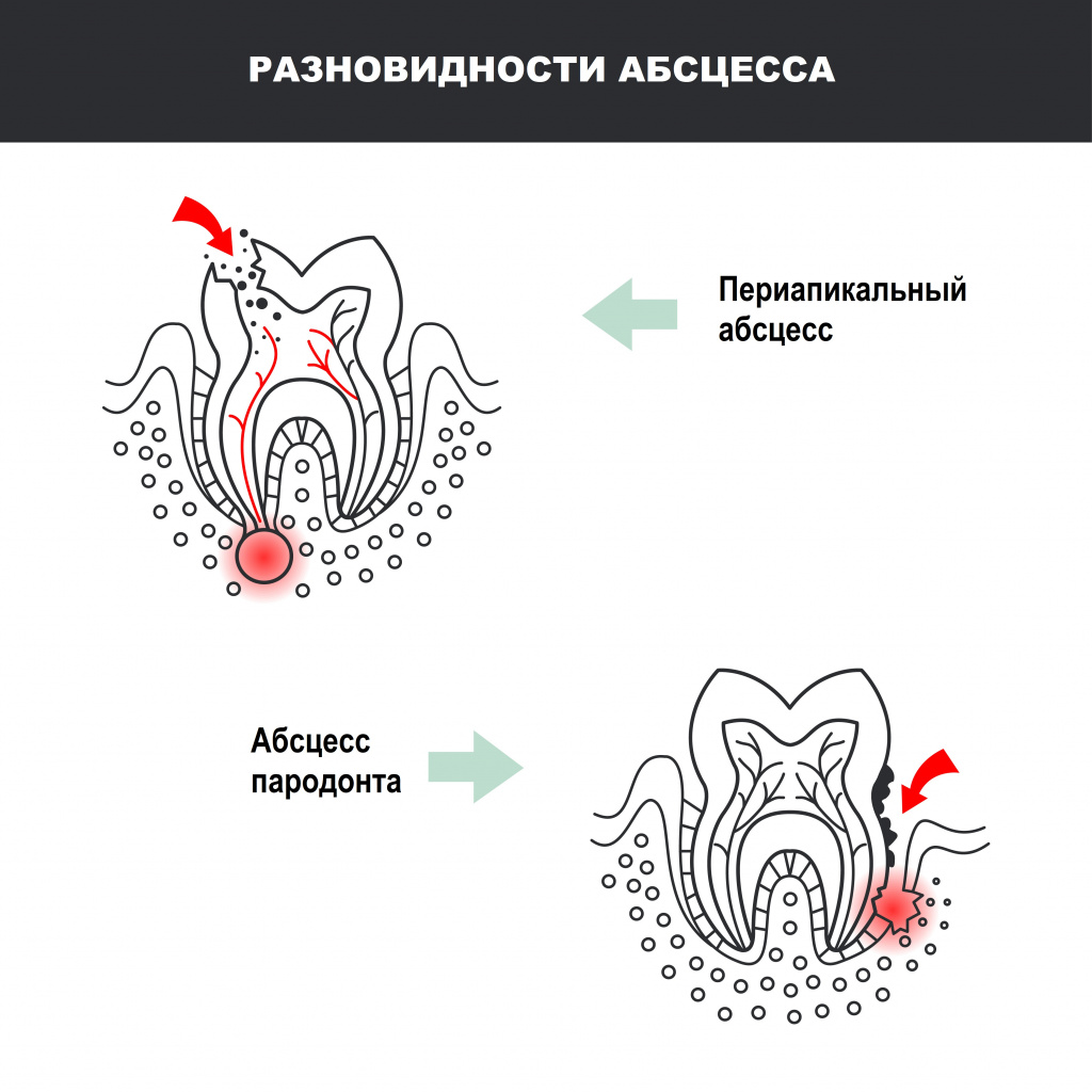 Абсцесс.jpg Абсцесс.jpg