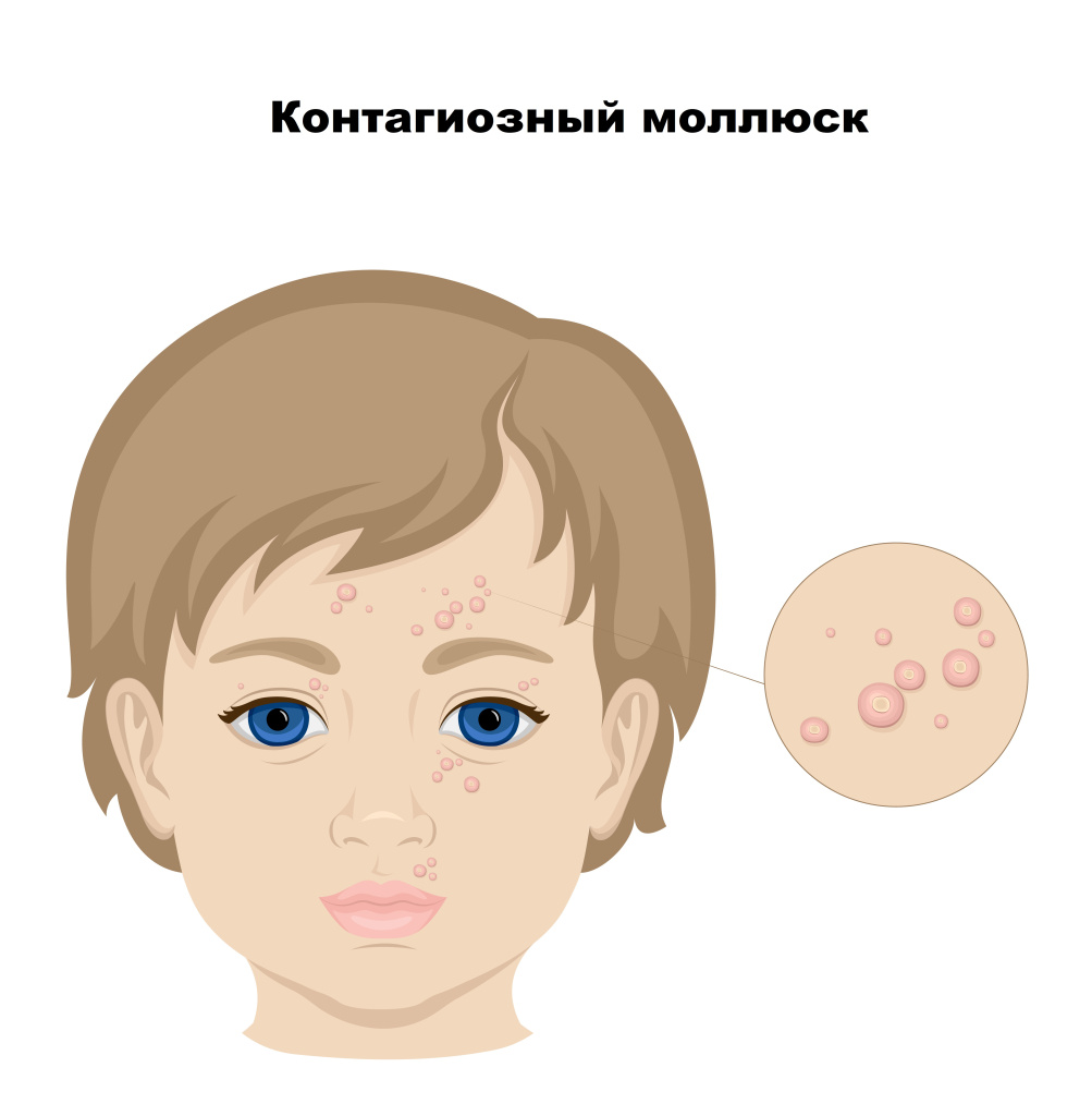 Как выглядят моллюски на человеке Контагиозный моллюск - симптомы по дням у детей и взрослых, диагностика и способ