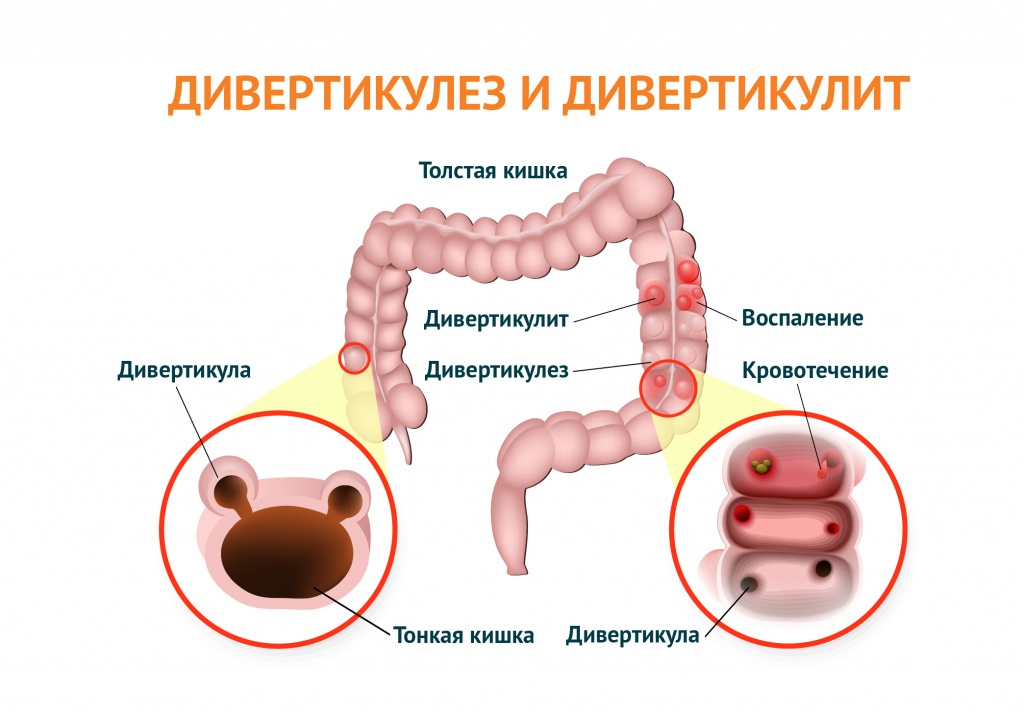 Симптомы газообразования в кишечнике на фоне нехватки ферментов