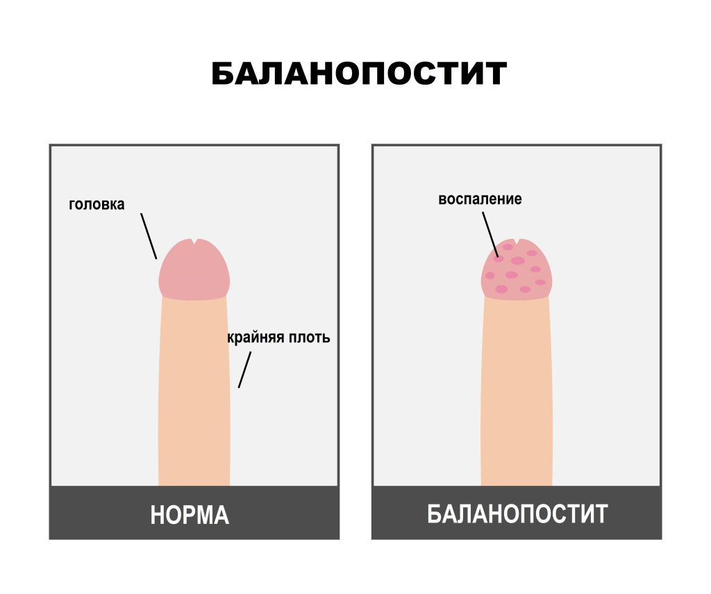 Покраснение на головке и крайней плоти. Что делать и как лечить?