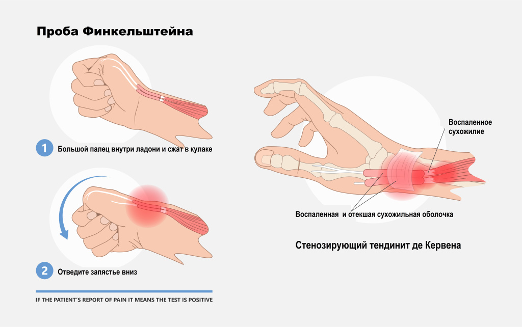 Тендовагинит.jpg