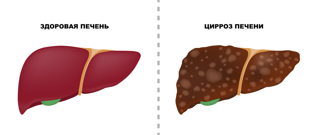 Цирроз печени.jpg