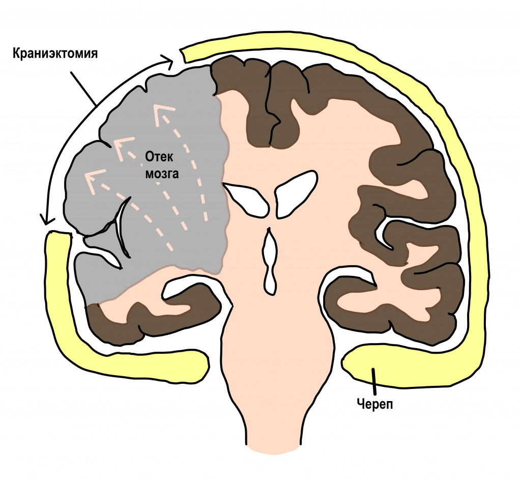 Brain 71. Птериональная краниоэктомия. Отёк мозга симптомы у взрослых. Отек головного мозга у новорожденных.