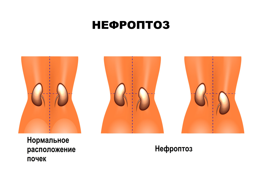 нефроптоз.jpg