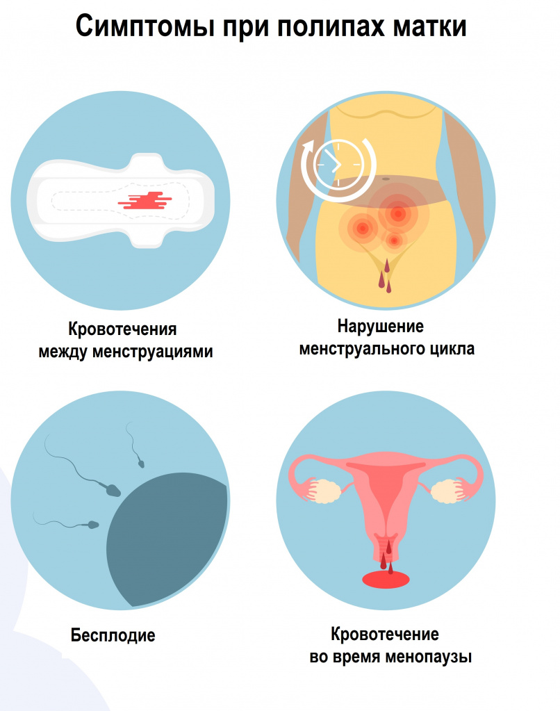 Определение. Что такое полип в матке