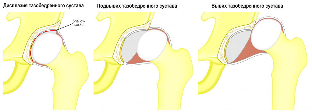 Тазобедренный сустав.jpg Тазобедренный сустав.jpg
