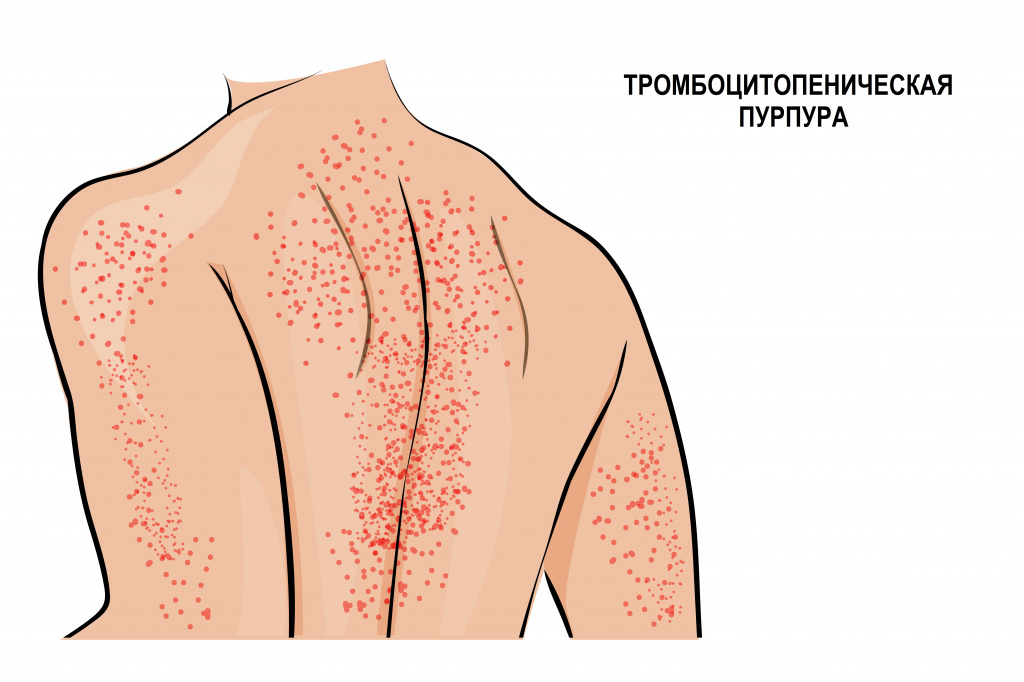Основные симптомы тромбоцитопении