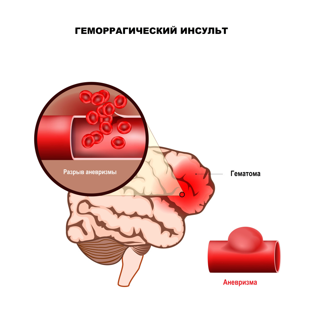 Инсульт.jpg