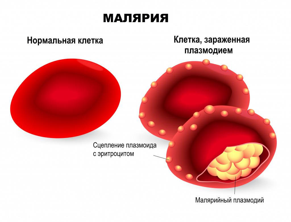 Малярия какая болезнь