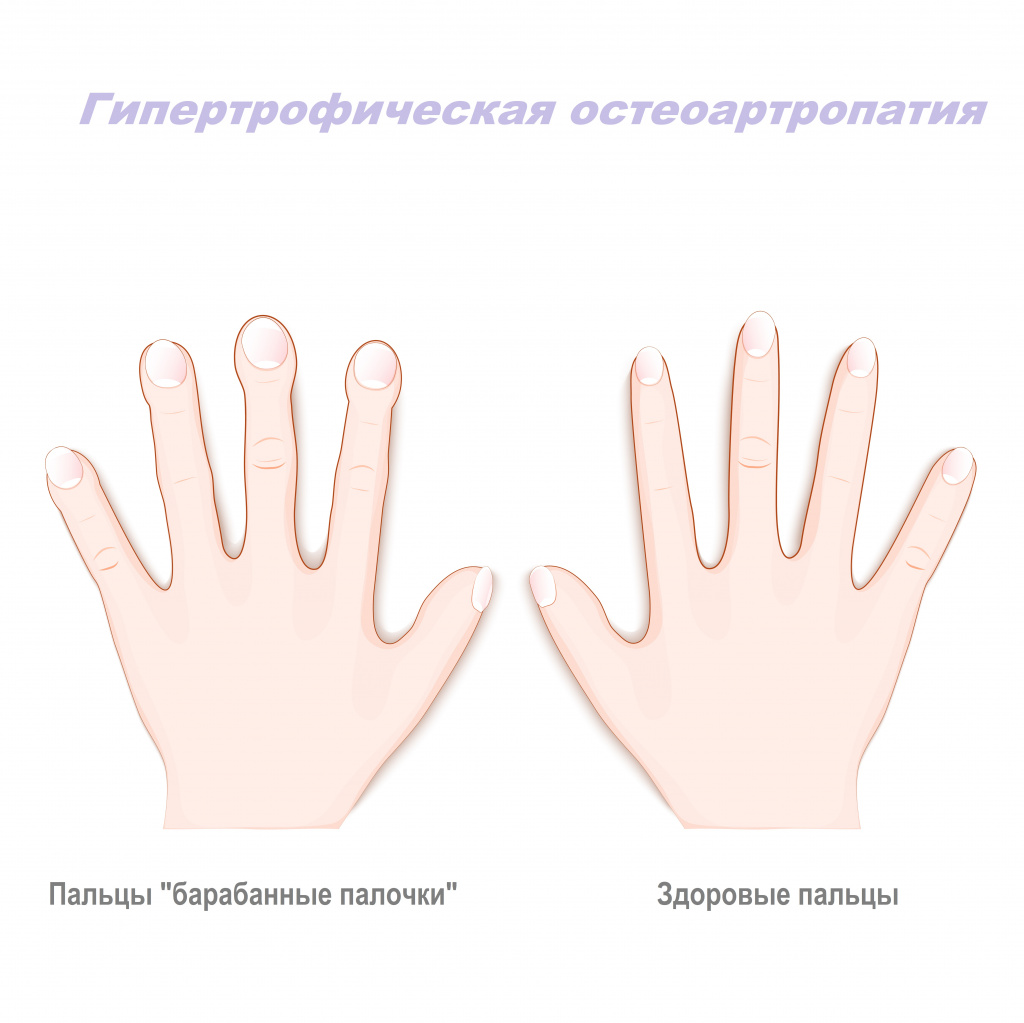 Артрит руки и пальцев лечение