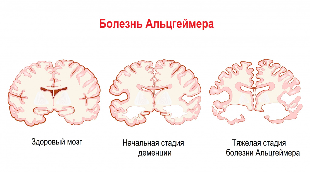 Болезнь Альцгеймера.jpg