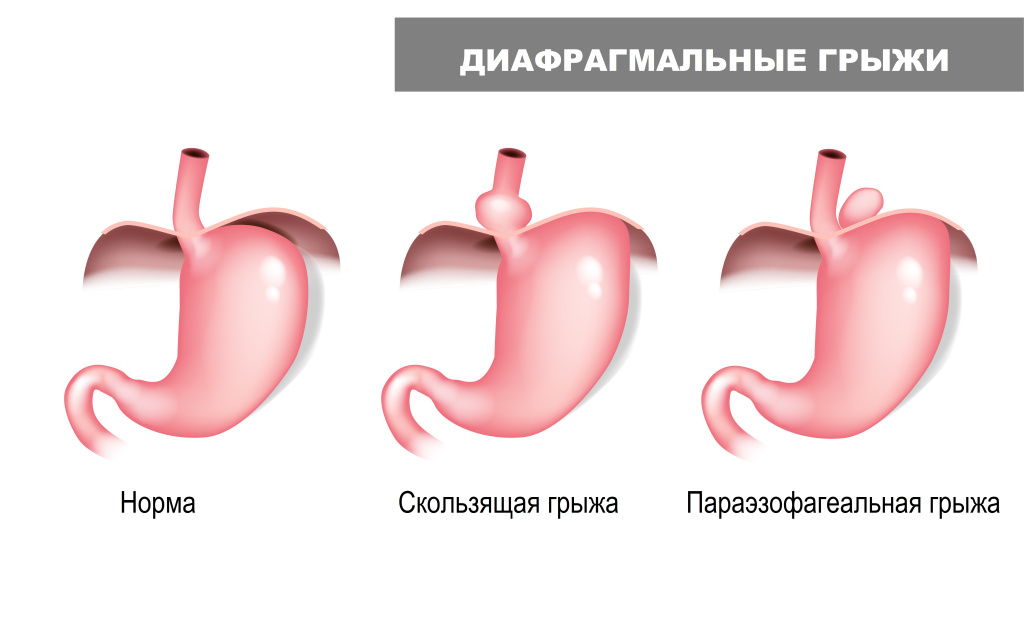 Грыжа.jpg