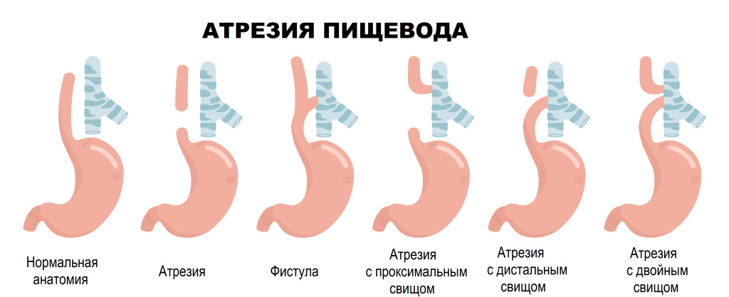 Атрезия.jpg