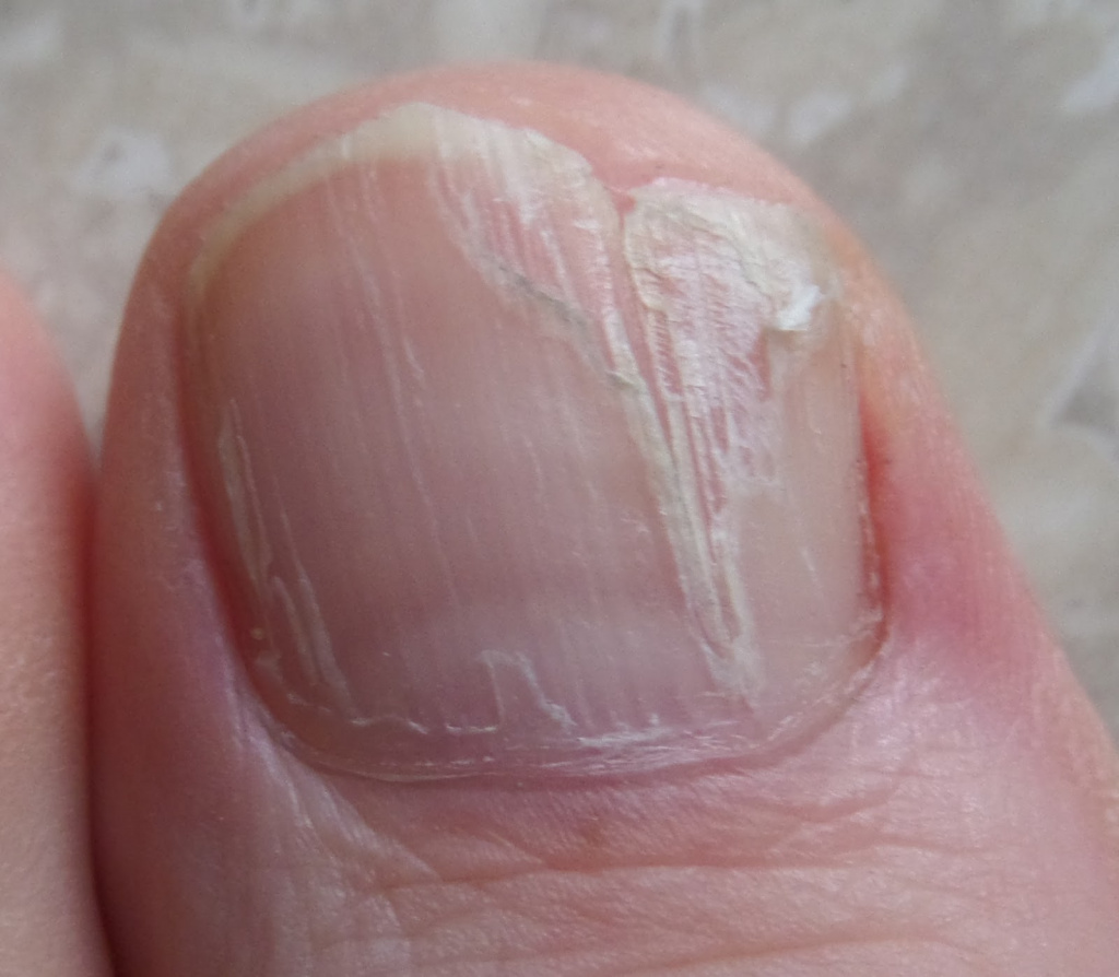 Трескаются ногти – почему и что делать? Домашние средтва