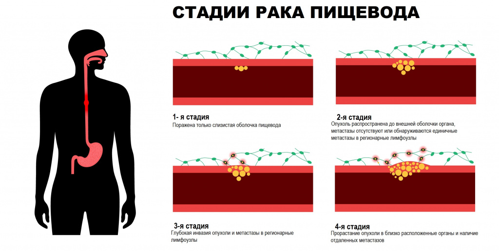 Стадии рака пищевода.jpg