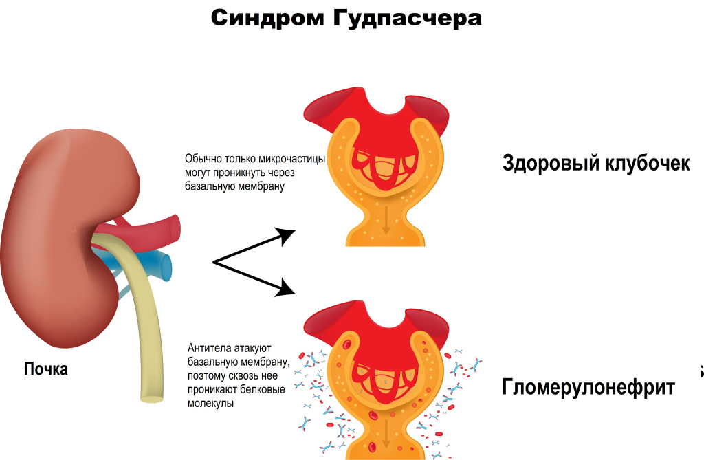 Синдром.jpg