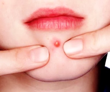 Getting-rid-of-pimples.jpg
