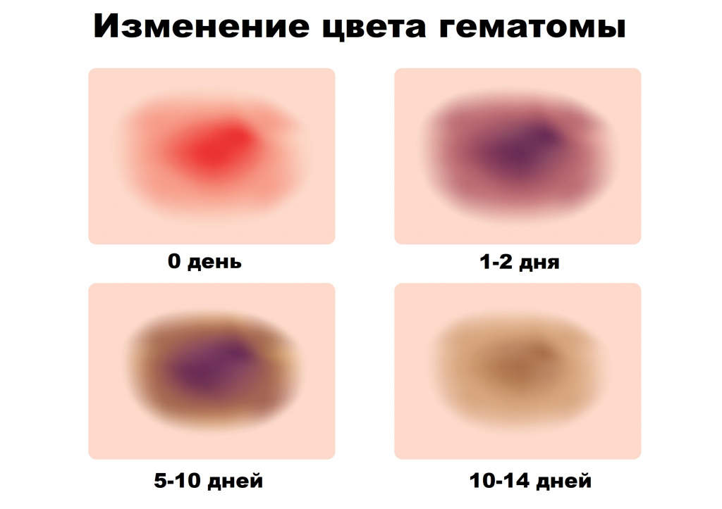 Ушиб мягких тканей: первая помощь, виды, лечение