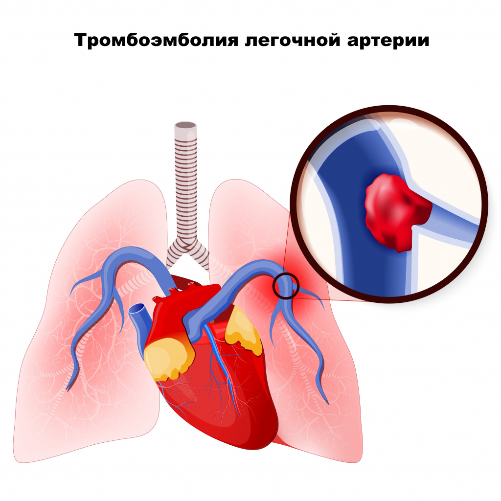 Тромбоэмболия легочной артерии (ТЭЛА, легочная тромбоэмболия) - лечение и  симптомы у взрослых, причины появления, диагностика и анализы, какой врач  лечит