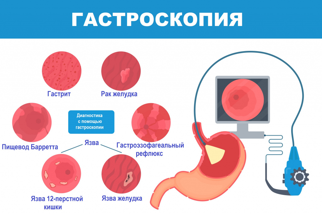 Гастроскопия.jpg