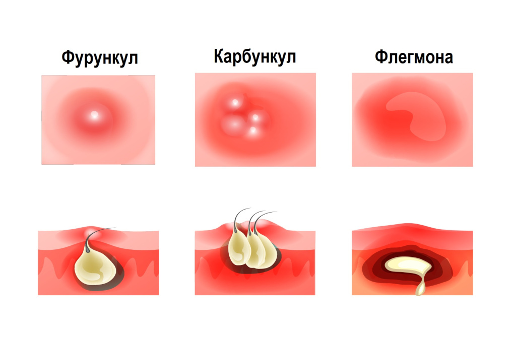 Карбункул.jpg