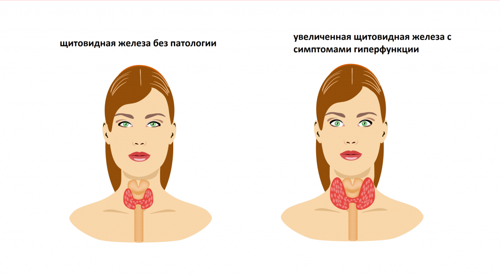 щитовидная железа гиперфункция.png